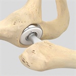 پروتز بایپولار