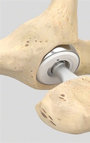 پروتز بایپولار